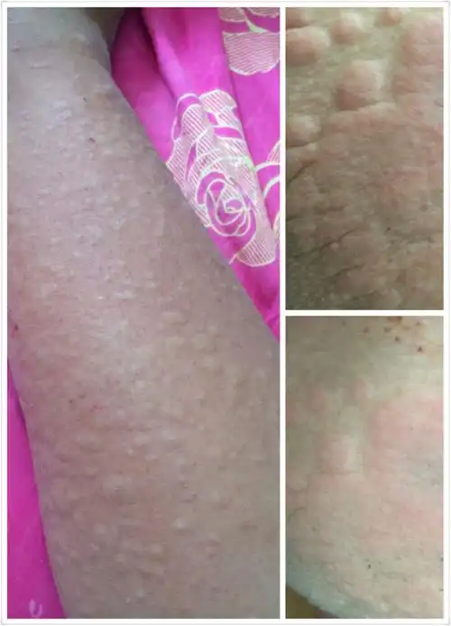 孕晚期湿疹宝妈看过来,希望能帮到你们