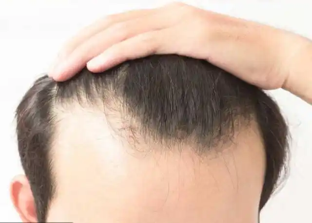 发际线后移怎么办?什么原因导致的?