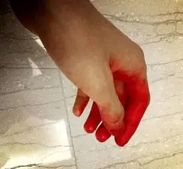 手受伤真实的图片带血 - 搜狗图片搜索