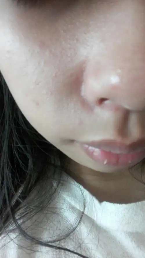 这个是脂肪粒吗 油性皮肤 夏天的时候跟明显