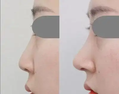 假体隆鼻前后对比图