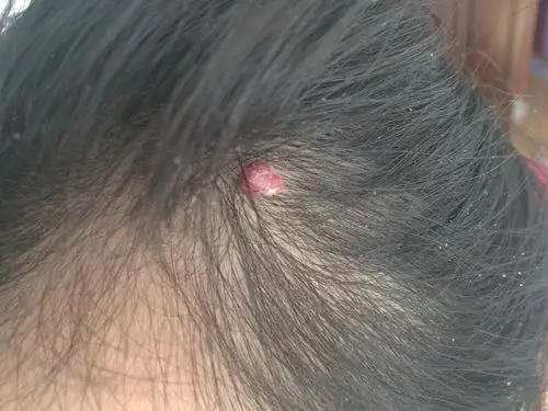 头上长个小肉瘤,请问什么原因,怎么治?