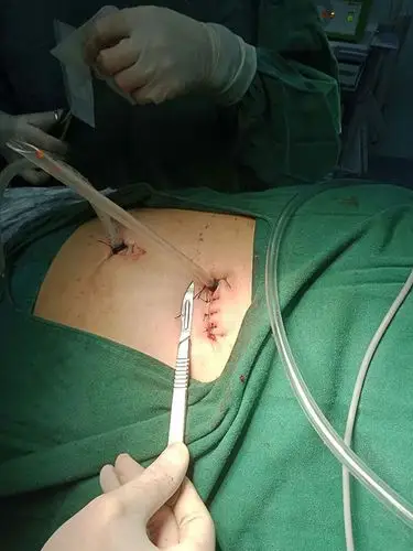 胸腔镜手术创伤小,不损伤肌肉,不切断肋骨,创伤小,疼痛轻,恢复快,是