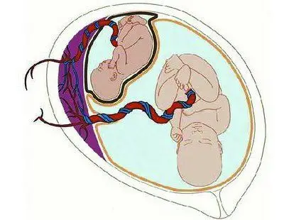 怀的是双胞胎 却只生下一个