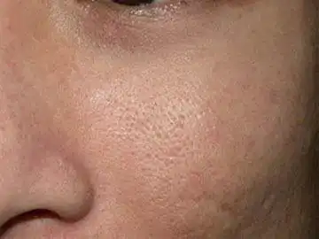 毛孔粗大的真正原因您可能想不到