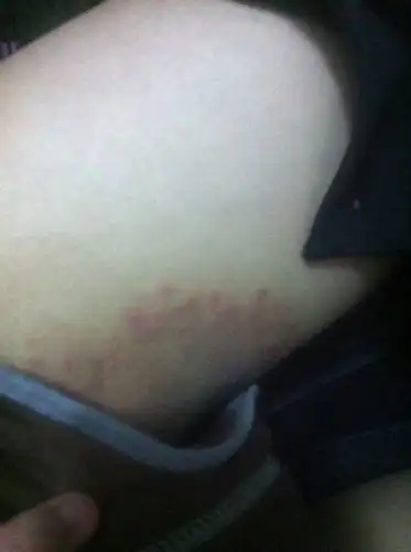 医生这是大腿一侧的地方是不是湿疹建议