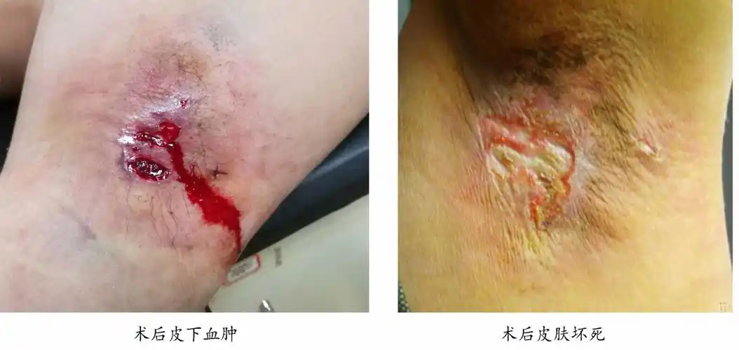 缺点是腋部皮下血管网破坏严重,术后容易发生皮下血肿和皮肤坏死,且术