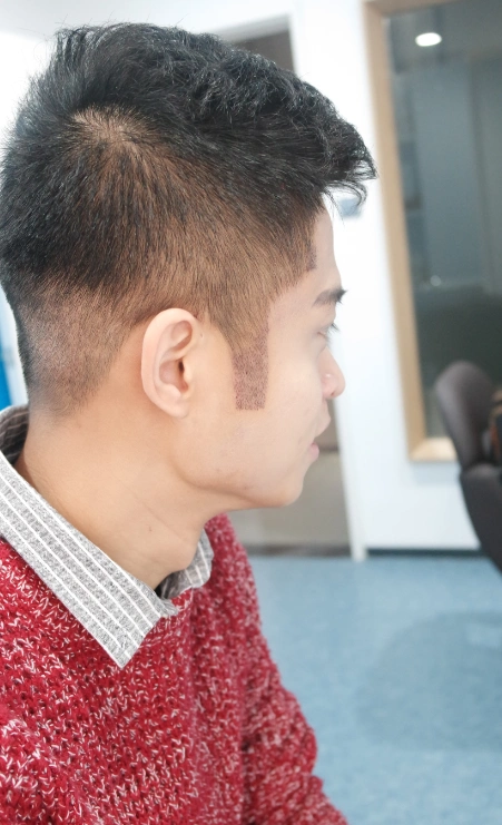 龟毛完美主义者刘桂彬霸气鬓角种植术后四天