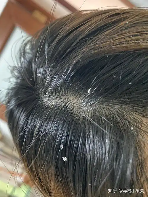 见过的最大头皮屑多大