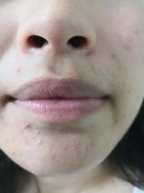 解决皮肤问题专注皮肤美容##痤疮##马拉色菌毛囊炎