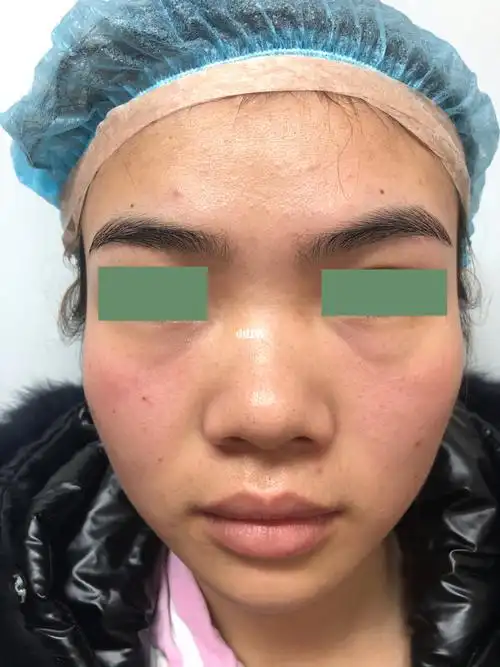 今日手术看一下原机相机下的小趴鼻子