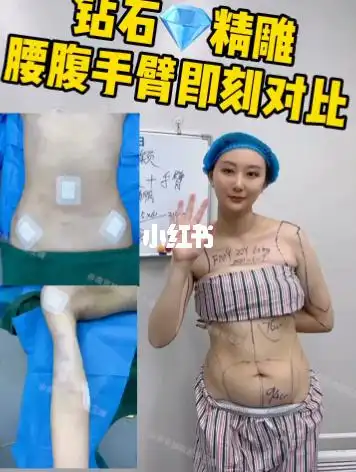 钻石96精雕腰腹环吸手臂即刻对比_钻石_腰腹_紧肤_吸脂_吸脂的话题