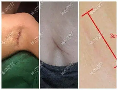 术后腋下切口恢复情况