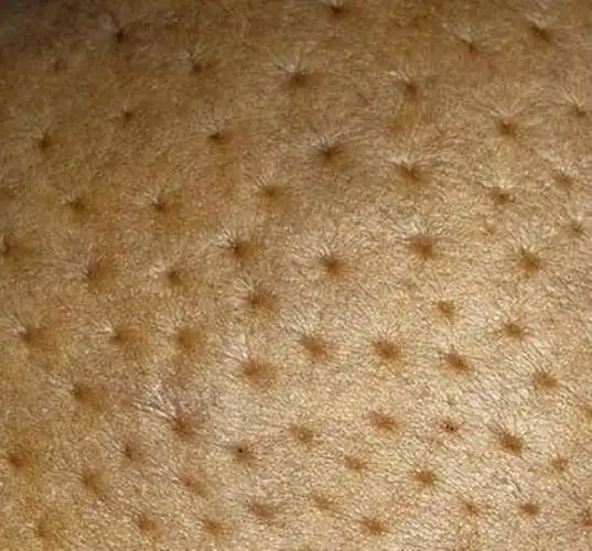 使其缩短并失去弹性,牵拉相应部位的皮肤,出现"酒窝征",即乳腺皮肤