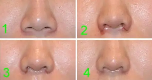 鼻孔缩小术效果怎么样?