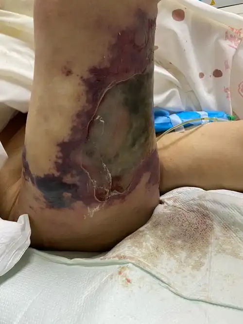 一例极速进展性皮肤坏死病例分享