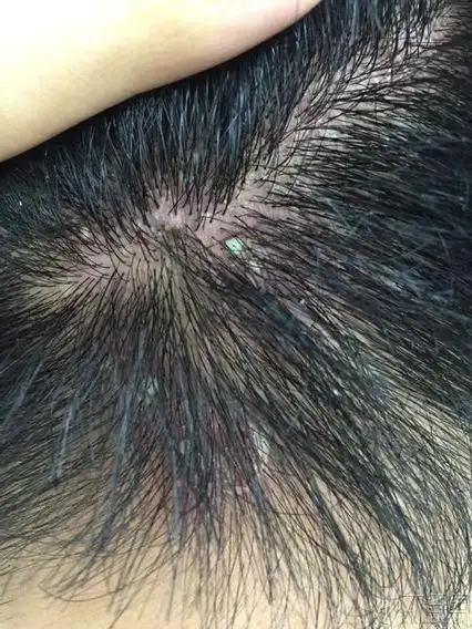 顽固的头面部毛囊炎,求高手指点 [病例帖]
