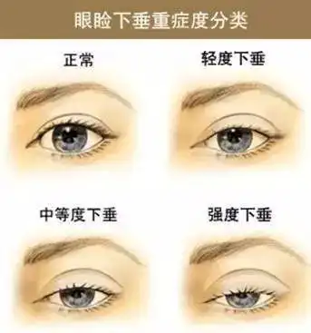 【涨点姿势】自测:你的眼睑下垂了吗? - 99短媒 - 短视频运营推广学习