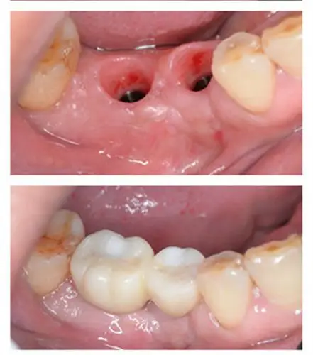 温州爱牙故事种植牙真实案例