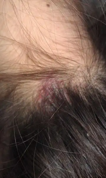 脖子后面的发根起了像痘痘一样的东西