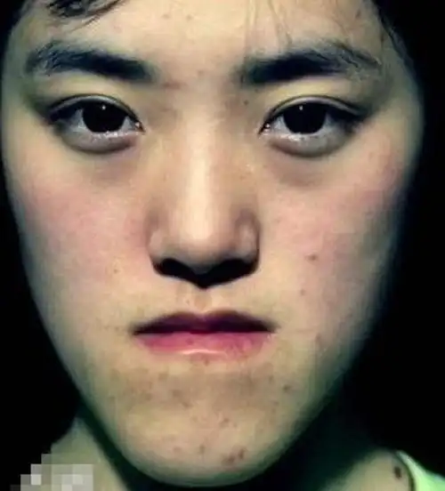 小孩地包天牵引器