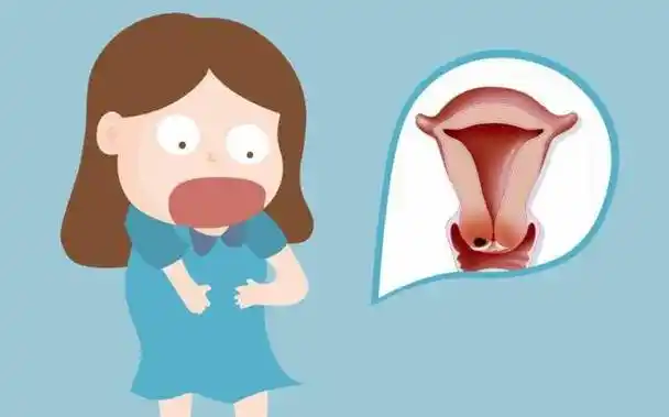 宫颈癌多是"拖"出来的?