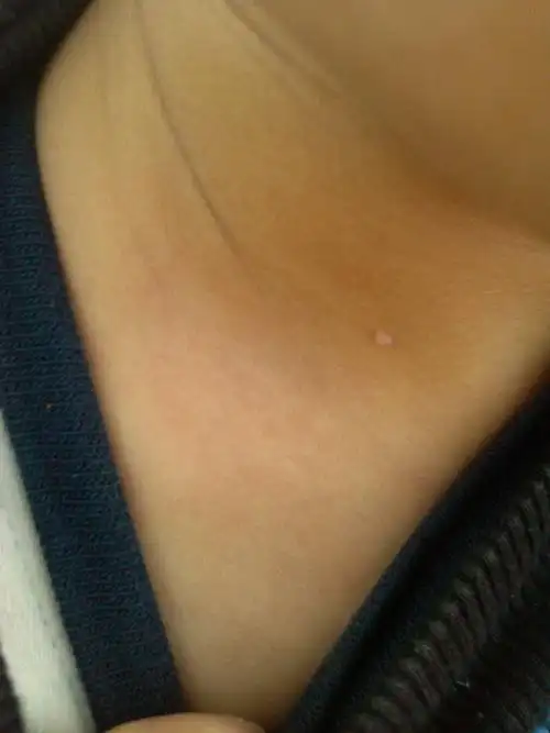 我儿子一岁九个月,一岁前脖子处就有这样的小疙瘩,到现在又长了几个