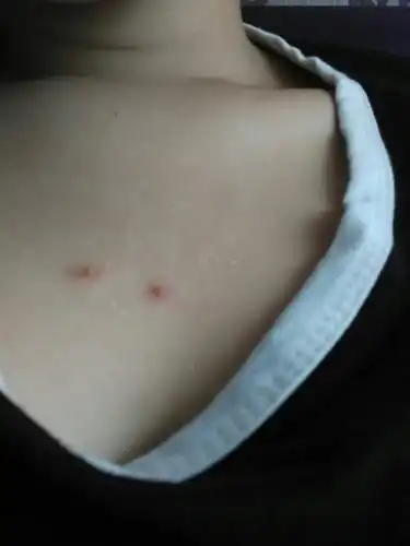 胸口长这两个红疙瘩很长很长时间了,不痛也不痒,也下不去,很苦恼,这是