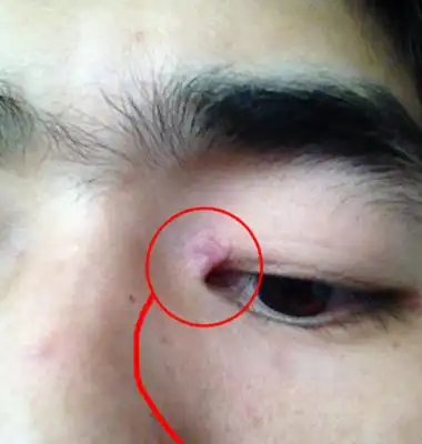 眼角长了个疙瘩图片 (16)_有来医生