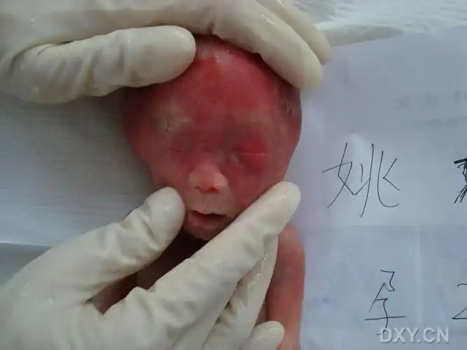 【共享】典型胎儿引产后图片