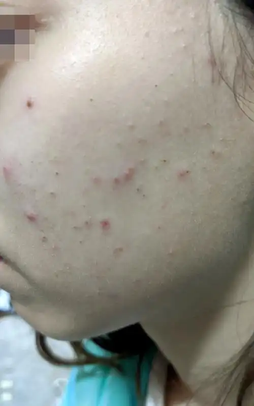 脸上有黑头粉刺和闭口粉刺,还有毛囊炎