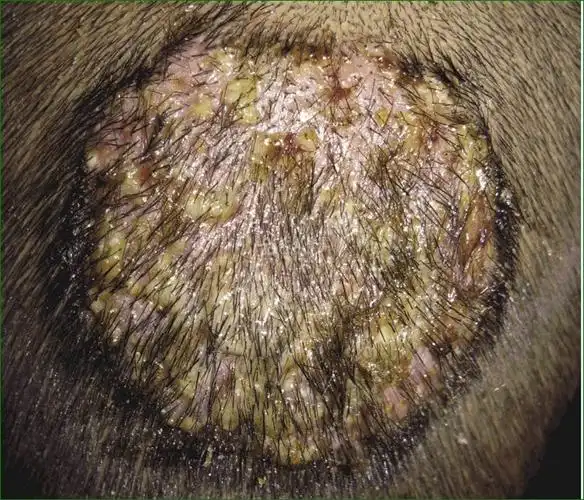 头癣的症状种类展示图片