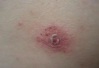疥疮症状图