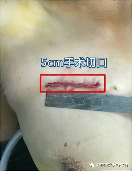 心脏瓣膜病微创手术 - 好大夫在线