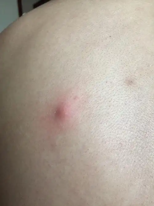 怀孕14周了,后背起了个这个,一碰就疼,是火疖子吗?