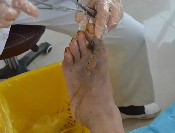 糖尿病人修个脚居然要截肢,究竟发生了什么?