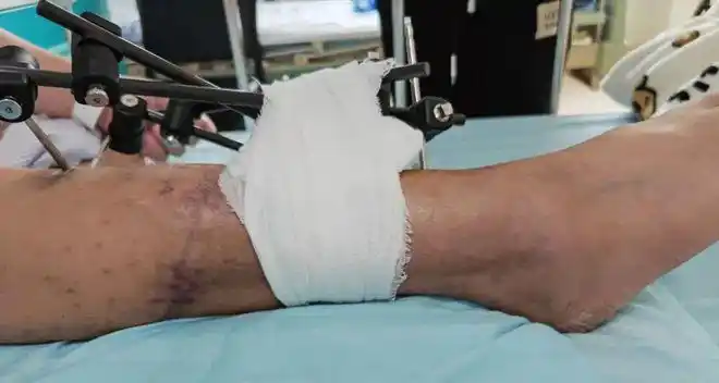 小腿离断3小时海南西部中心医院奋战7个多小时再植保肢成功