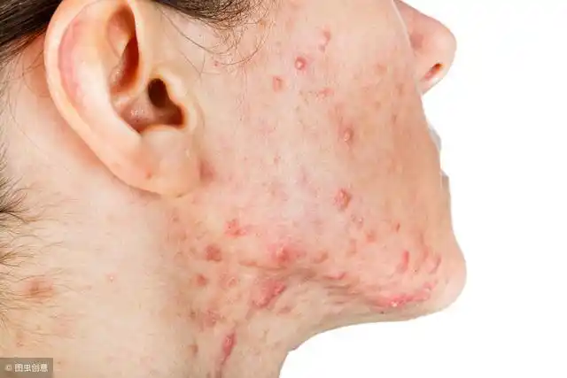 经常被失眠引起的皮肤病困扰?来试试这套助睡眠保健操吧