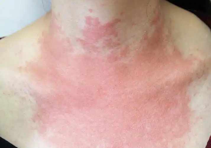 一文解析接触性皮炎