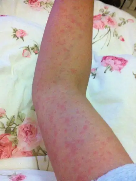 按时间排序 回答共3条 今天 01:31银行比公厕多|四级 皮疹或者过敏