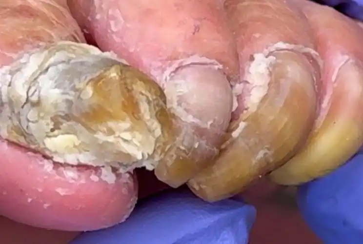 长指甲因细菌感染又长又硬