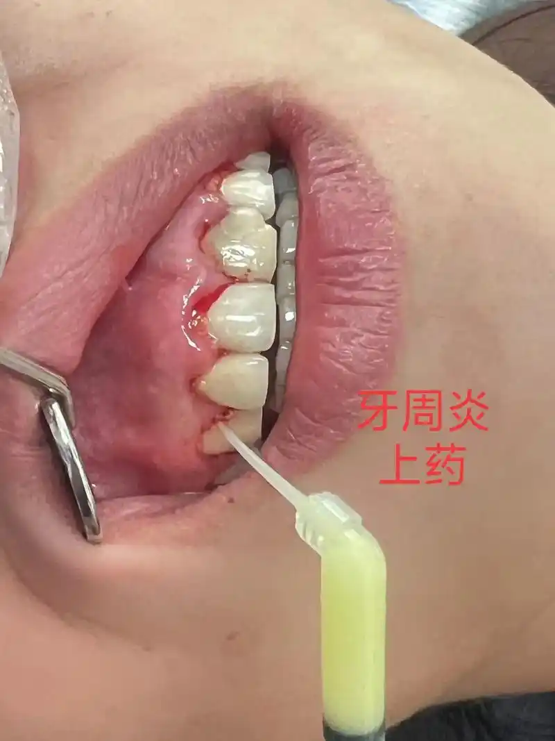 客人说早就知道自己的牙齿烂了,因为怀孕,生完宝宝后更没有时间 - 抖