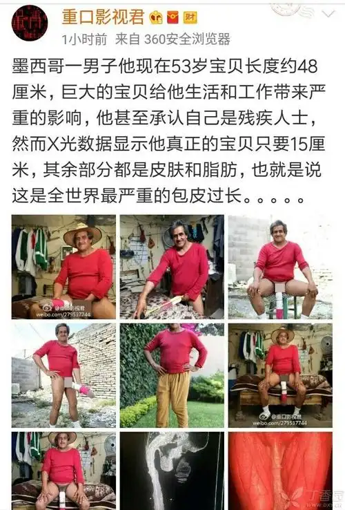 可能是世界上人最大的阴茎 [病例帖]
