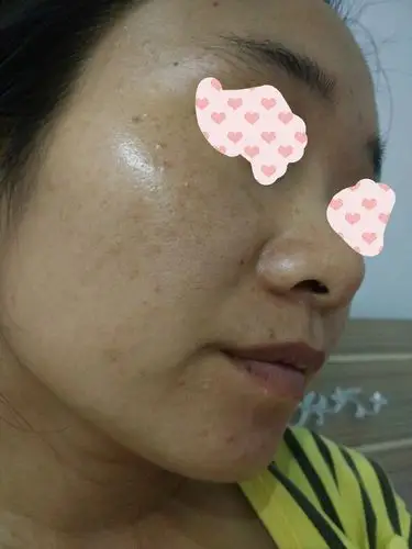 我27岁,混合偏油皮肤,早晨起来总是油腻腻的,角质层薄