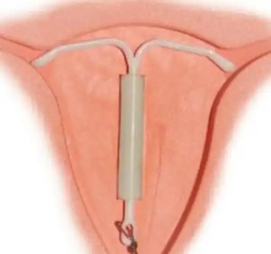 女人为了爱情选择上环,但是不知道上环对自己的伤害有多大