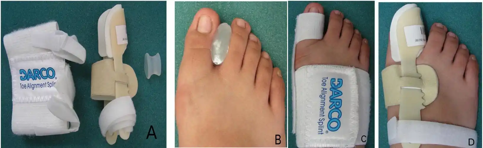 拇外翻(大脚骨)_拇外翻_疾病介绍_介绍 - 好大夫在线