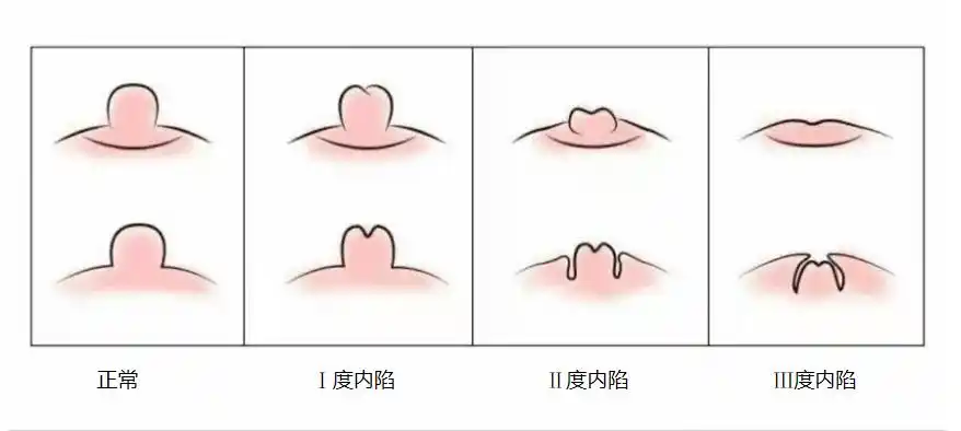 乳头内陷是怎么回事?与乳腺癌有关吗?_乳晕_炎症_治疗