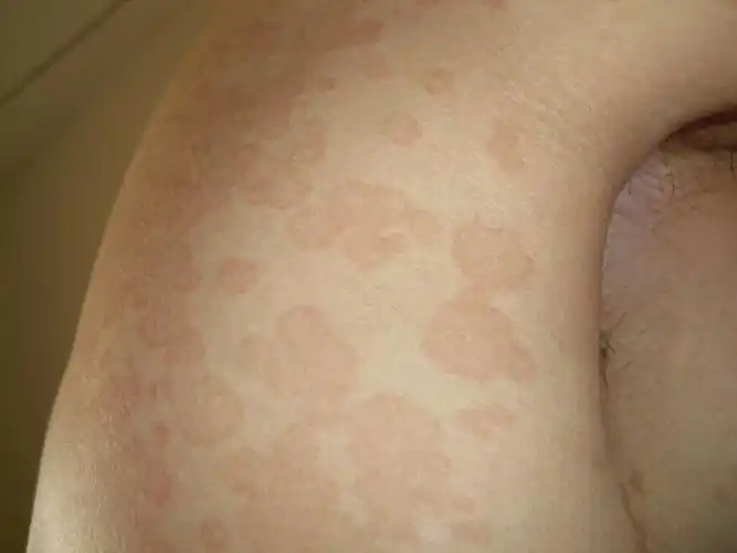 奇怪的皮肤病,请高手诊断?