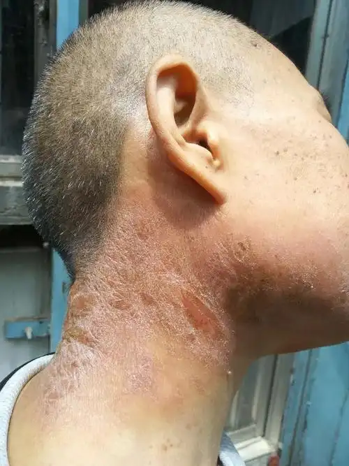 王丹丹医师 | 30年严重皮肤病,3周明显改善