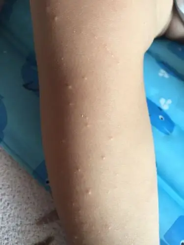 一岁半的宝宝身上起了很多肉色的小粒粒,不知道是什么